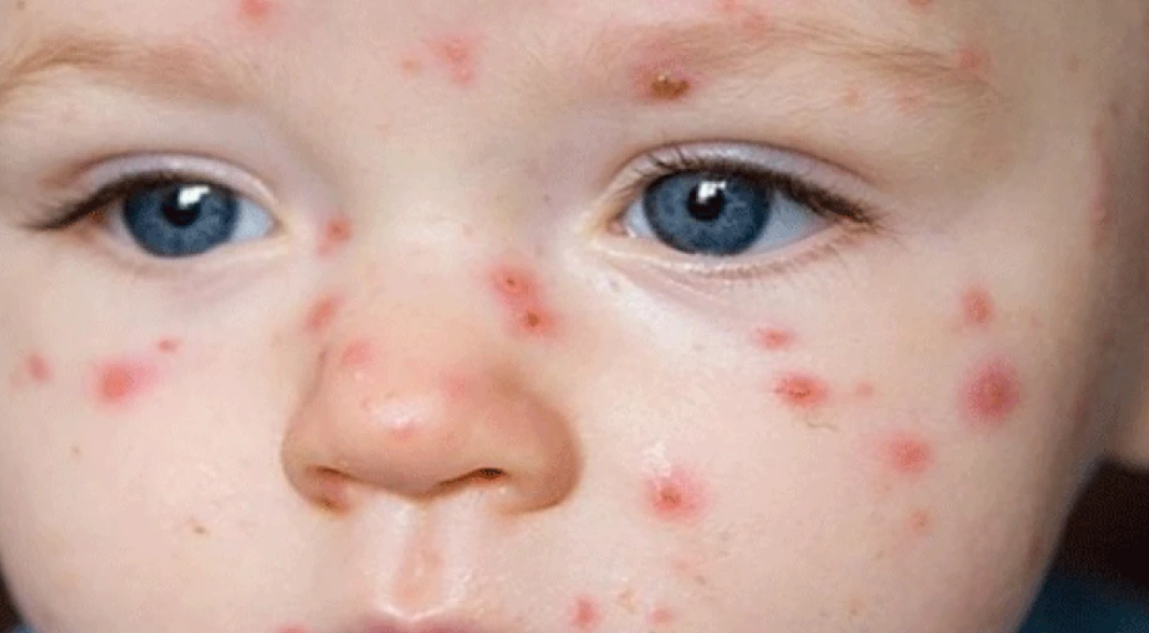 Kızamık virüsü, measles virus adlı bir virüs tarafından neden olan bulaşıcı bir hastalıktır