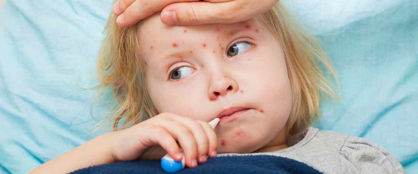 Kızamık virüsü, measles virus adlı bir virüs tarafından neden olan bulaşıcı bir hastalıktır
